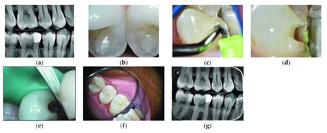 Slot cavity preparation on a distal carious lesion of an upper .